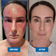Before and after comparison of a woman's face with visible skin condition improvement.
