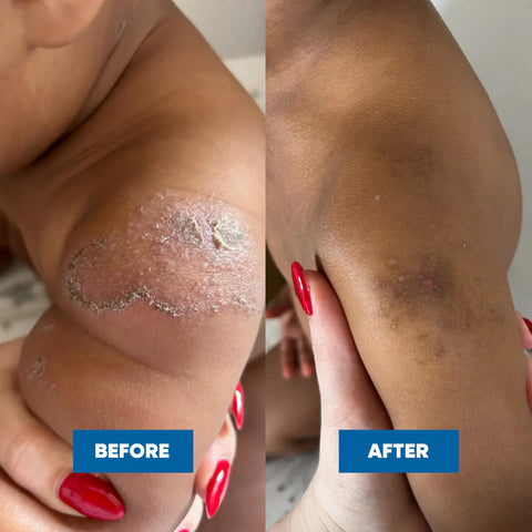 Before and after comparison of a knee with a patch of skin condition.