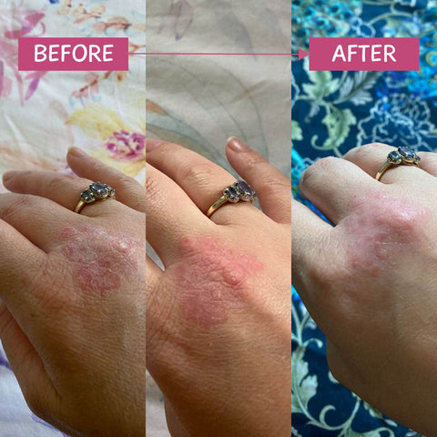 Before and after comparison of a hand with eczema, showing gradual improvement.