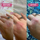 Before and after comparison of a hand with eczema, showing gradual improvement.