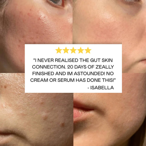Before and after comparison of skin with a 5-star rating text overlay of Zeally Herbs Intestinal Parasite Cleanse.